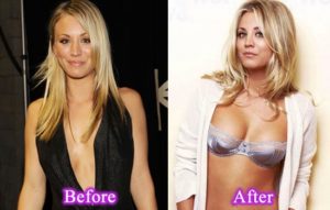 kaley-cuoco-breast-implants